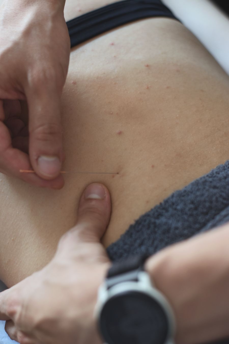 Close-up of a dry needling trigger point technique on the back
